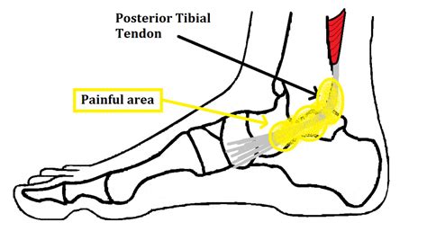 89 Other specified enthesopathies of. . Icd 10 posterior tibial tendonitis